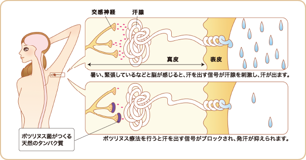 暑い、緊張しているなどと脳が感じると、汗を出す信号が汗腺を刺激し、汗が出ます。/ボツリヌス療法を行うと汗を出す信号がブロックされ、発汗が抑えられます。