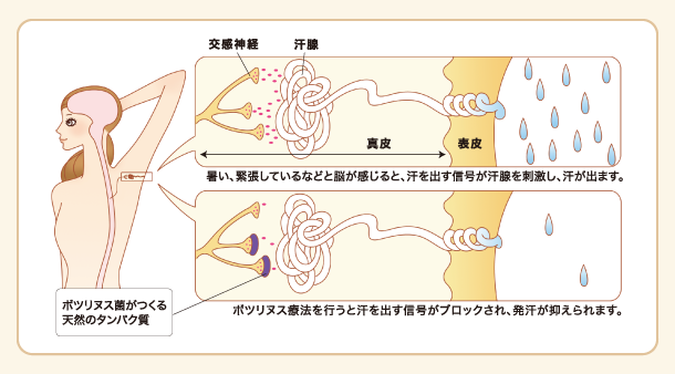 暑い、緊張しているなどと脳が感じると、汗を出す信号が汗腺を刺激し、汗が出ます。 ボツリヌス療法を行うと汗を出す信号がブロックされ、発汗が抑えられます。